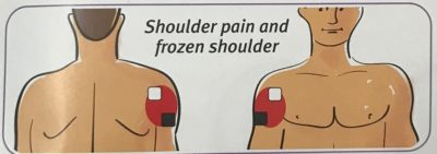 TENS pad placmeent for shoulder pain